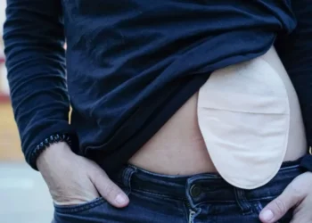 A bolsa de colostomia serve para armazenar as fezes após a cirurgia de colostomia • Sheila Alonso/GettyImages