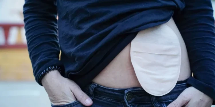 Bolsa de colostomia: o que é, para que serve e cuidados