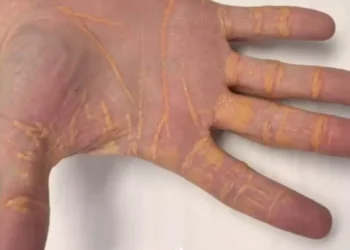 Xantelasma é uma condição caracterizada pelo acúmulo de colesterol logo abaixo da superfície da pele • JAMA/Divulgação