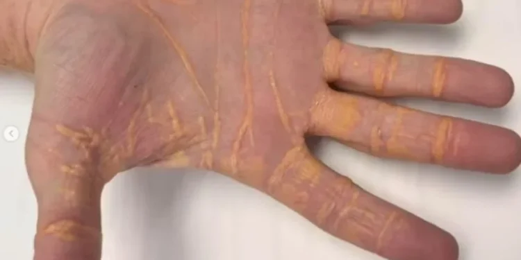 Xantelasma é uma condição caracterizada pelo acúmulo de colesterol logo abaixo da superfície da pele • JAMA/Divulgação