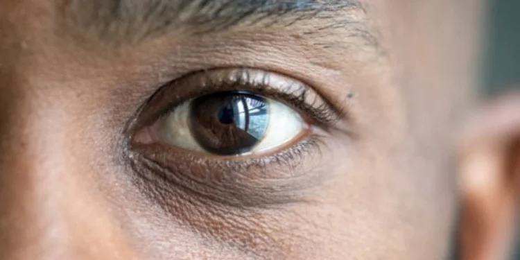 Onda de calor exige cuidados com a saúde ocular