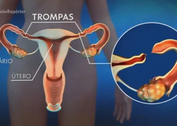 A laqueadura é uma cirurgia na trompa, o canal que liga o ovário até o útero — Foto: Arquivo/TV Globo
