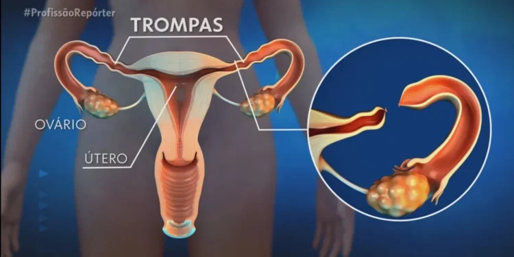 A laqueadura é uma cirurgia na trompa, o canal que liga o ovário até o útero — Foto: Arquivo/TV Globo