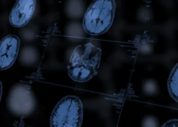 IA detecta anormalidades cerebrais invisíveis em pessoas com epilepsia