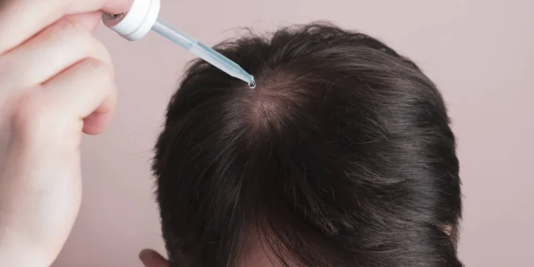 Minoxidil pode causar crescimento anormal de pelos em bebês, alerta Anvisa