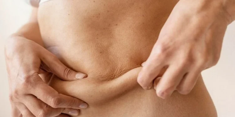 Lifting corporal cresce como cuidado estético após canetas emagrecedoras