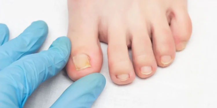 Descubra os tratamentos mais eficazes para micose de unha, o que realmente funciona e quando é hora de procurar um dermatologista / crédito: Henadzi Pechan de Getty Images