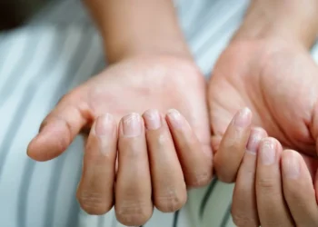 O estado das unhas pode refletir a saúde geral do organismo, segundo especialista • PORNCHAI SODA/GettyImages