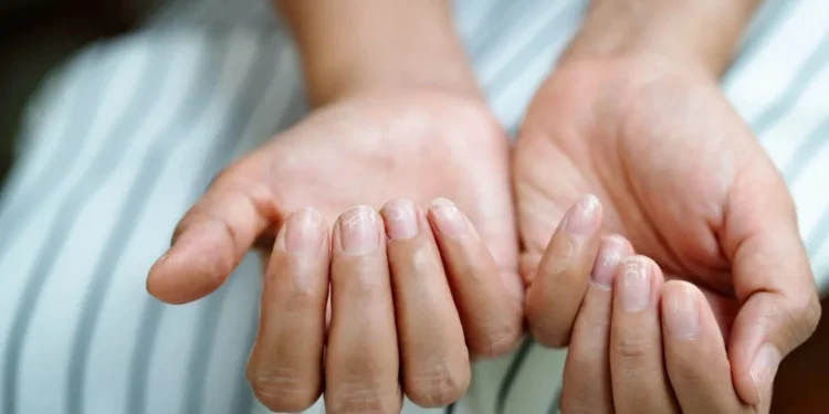 O estado das unhas pode refletir a saúde geral do organismo, segundo especialista • PORNCHAI SODA/GettyImages