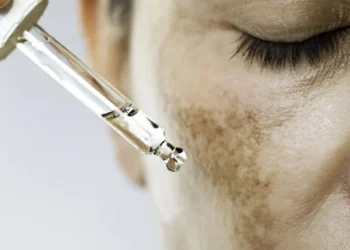 Condição é marcada pelo surgimento de manchas escuras na região da face • Getty Images