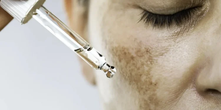 Condição é marcada pelo surgimento de manchas escuras na região da face • Getty Images