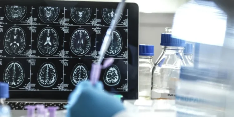 Kisunla é um medicamento injetável, administrado uma vez por mês, e é o primeiro e único tratamento aprovado no Brasil direcionado à placa amiloide • Getty Images/Science Photo Libra