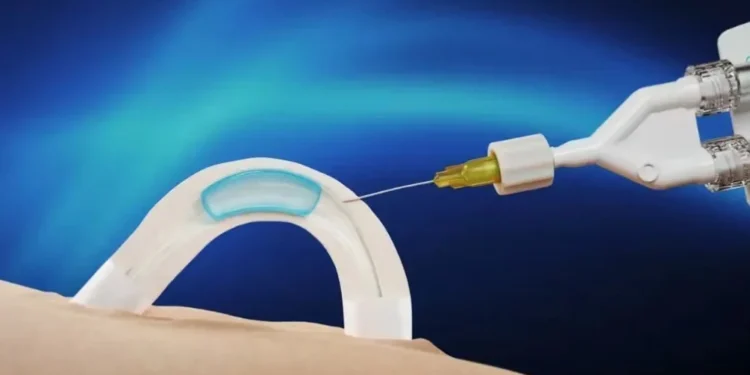 Adam é um hidrogel solúvel em água que é implantado nos canais que transportam o esperma • Contraline/Divulgação