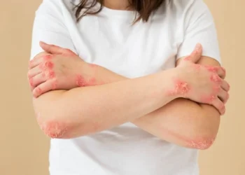 Lúpus: se trata de uma doença autoimune bem complexa e que ainda intriga a medicina
crédito: Freepik