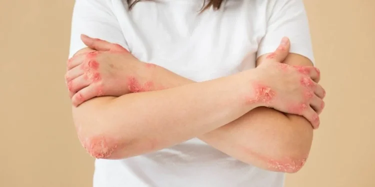 Atenção ao lúpus: a doença autoimune atacada pelo sistema imunológico