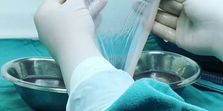 Membrana amniótica coletada na hora do parto será usada em queimaduras — Foto: Divulgação/SantaCasaPOA