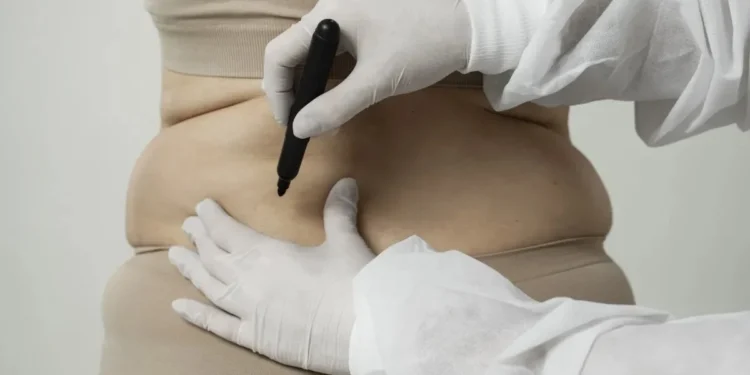 Cirurgia bariátrica é para quem não responde a tratamentos, diz médico