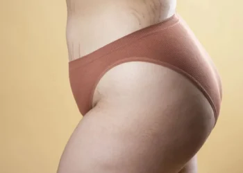 Estrias podem ser potencializadas por diferentes fatores  • Freepik