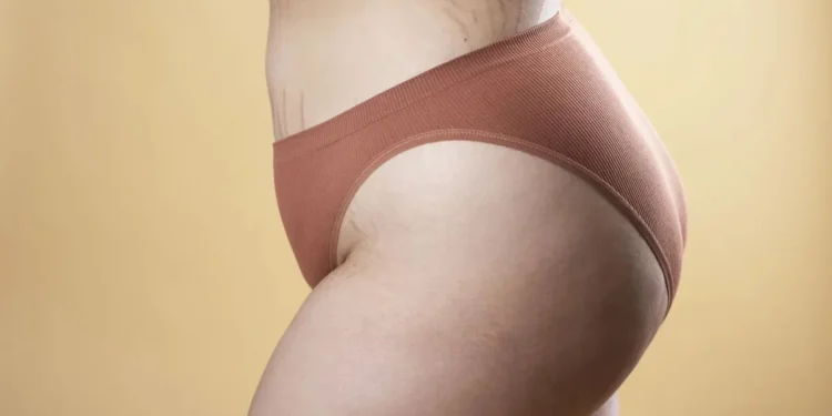 Estrias: o que são, como surgem e quais tratamentos disponíveis