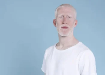 Sem a prevenção, albinos envelhecem precocemente e podem desenvolver cânceres de pele agressivos antes dos 30 anos de idade
crédito: Freepik/Divulgação