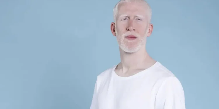 Albinismo: sancionada lei para proteger pessoas com a síndrome