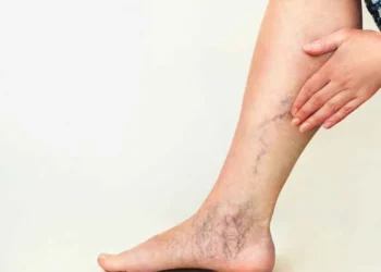 A prevalência de varizes varia de 2% a 30% em adultos, com maior risco em mulheres -
crédito: Guia da Farmácia/reprodução