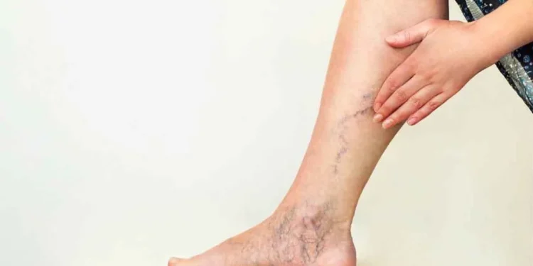 Hipersensibilidade ao frio, pé gelado e peso nas pernas? Pode ser varizes