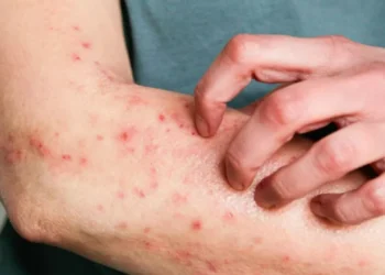 A urticária crônica espontânea é caracterizada por lesões vermelhas na pele, inchaço e coceira que pode ser dolorida  • Kinga Krzeminska/GettyImages