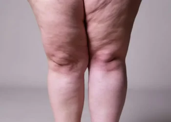 Lipedema é caracterizado pelo acúmulo irregular no corpo, enquanto o linfedema se caracteriza pelo acúmulo anormal de líquido linfático nas pernas e braços, causando inchaço persistente  • Staras/GettyImages