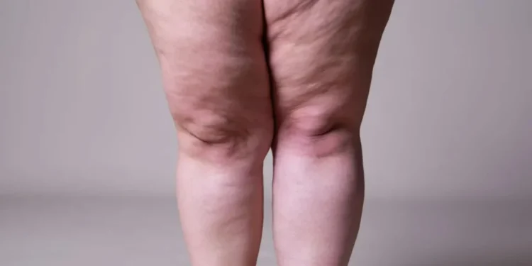 Lipedema e linfedema: entenda as diferenças e como tratar