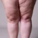 Lipedema e linfedema: entenda as diferenças e como tratar