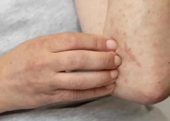 Diagnóstico da urticária é fundamental para a qualidade de vida da pessoa.  • Freepik