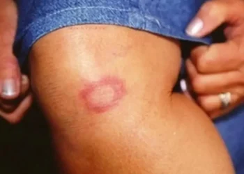 O Brasil ocupa, atualmente, a segunda posição no ranking global de países que registram novos casos de hanseníase
crédito: © Divulgação