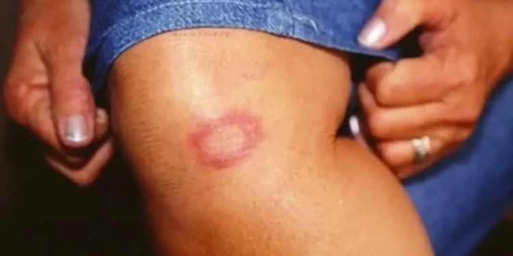 O Brasil ocupa, atualmente, a segunda posição no ranking global de países que registram novos casos de hanseníase
crédito: © Divulgação