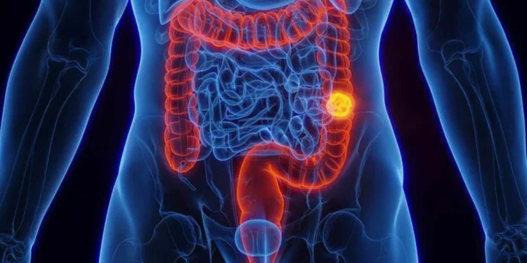 Por que câncer colorretal, que matou Preta Gil, cresce ‘assustadoramente’ em pessoas de até 50 anos