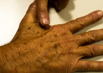 Esses tipos de câncer estão fortemente relacionados à exposição solar, além de fatores genéticos • Marcello Casal/Agência Brasil