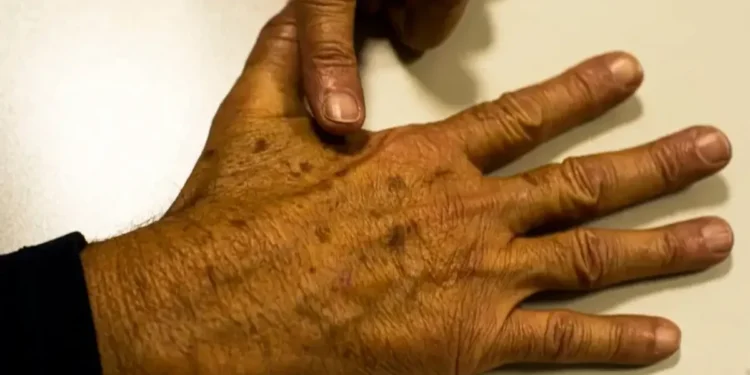 Casos de câncer de pele em idosos dispararam nas últimas três décadas