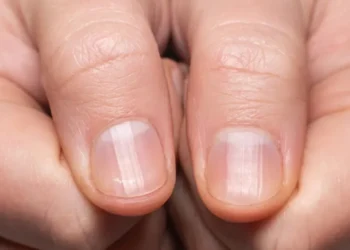 Unhas estriadas merecem atenção • Getty Images