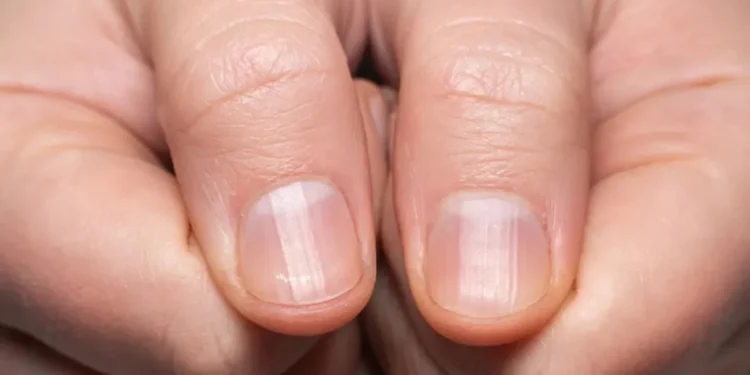 Unhas estriadas merecem atenção • Getty Images
