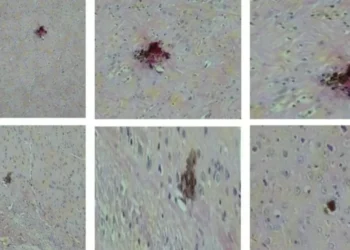 Lâminas histológicas com regiões do cérebro apresentando pontos de necrose nos animais não vacinados e infectados com vírus zika • Nelson Côrtes et al./NPJ Vaccines