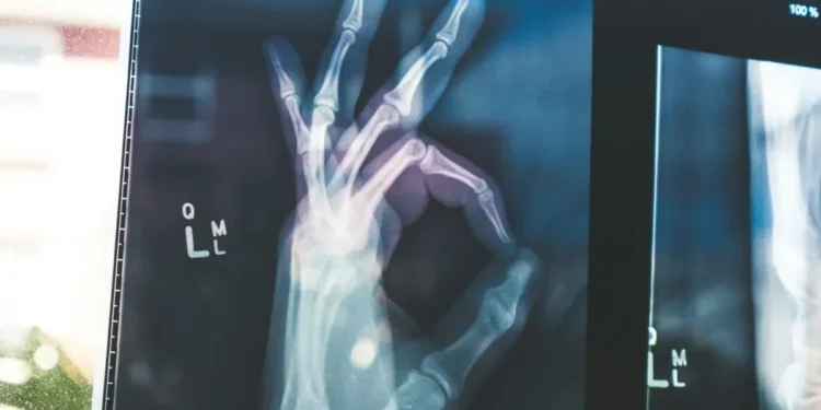 Ossos têm função endócrina: por que é importante prevenir osteoporose