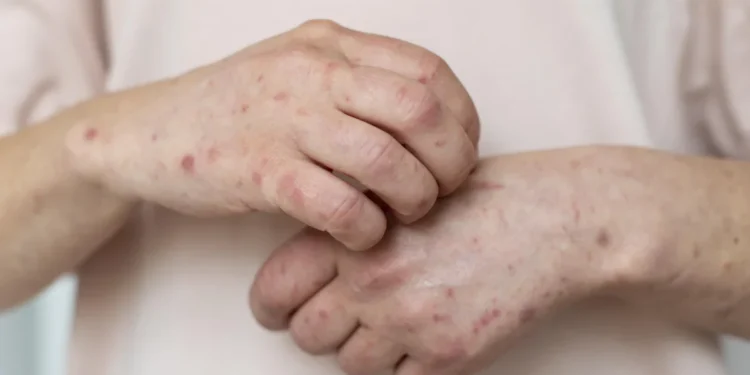 Tocantins registra 49 casos de sarampo e infectologista alerta para risco de contágio e importância da vacinação