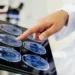 Cirurgia cerebral pode tratar depressão resistente; entenda como funciona