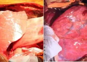 Pulmão no porco e após ser transplantado em um homem  • First Affiliated Hospital of Guangzhou Medical University and the National Clinical Centre for Respiratory Disease