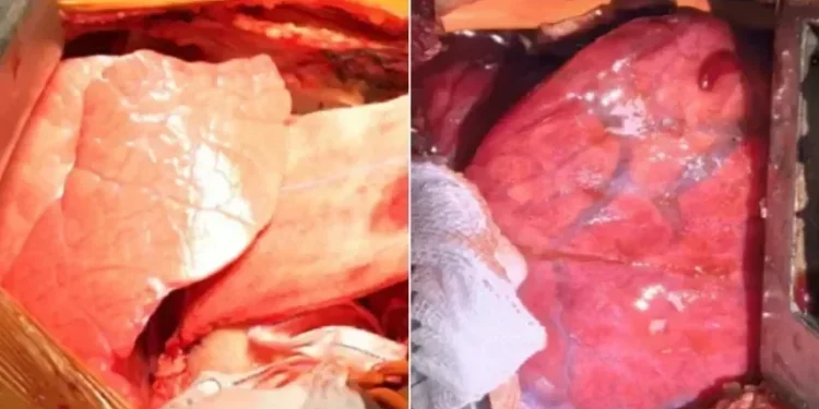 Pulmão no porco e após ser transplantado em um homem • First Affiliated Hospital of Guangzhou Medical University and the National Clinical Centre for Respiratory Disease