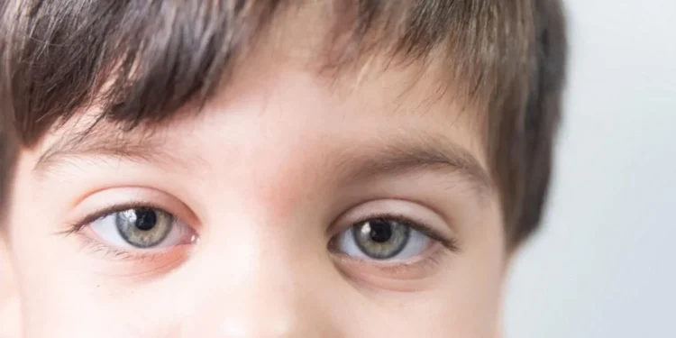 Ceratocone aumenta risco de catarata em jovens