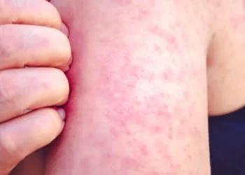 Vacinação é a principal forma de prevenção contra a rubéola e suas complicações crédito: iStock