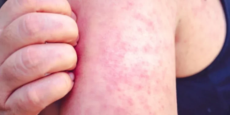 Vacinação é a principal forma de prevenção contra a rubéola e suas complicações
crédito: iStock