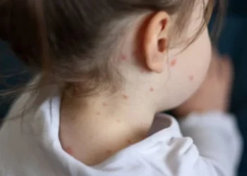 Manter a imunização em dia e reconhecer os sintomas rapidamente são atitudes fundamentais para evitar que a doença volte
crédito: iStock