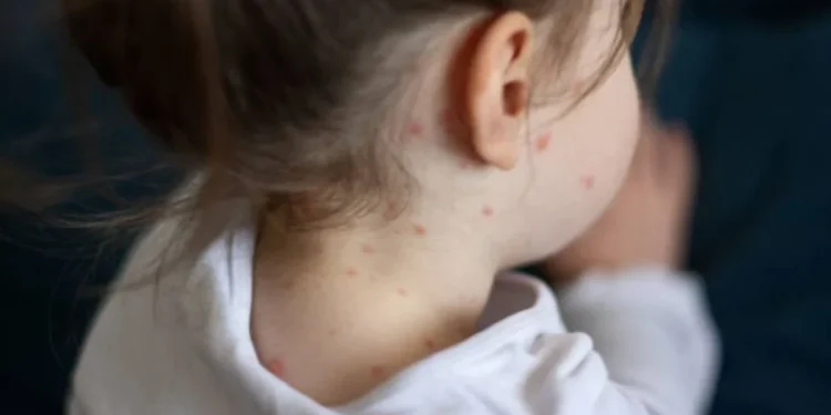 Manter a imunização em dia e reconhecer os sintomas rapidamente são atitudes fundamentais para evitar que a doença volte
crédito: iStock